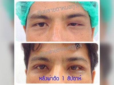 Dr Phuwadel  Eye center