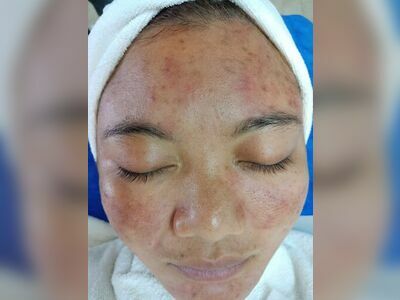 Krabi acne treatment Nanda