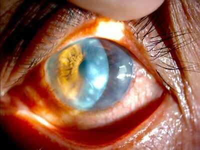 Ophthalmology Clinic Dr. Veerasak Lorungreung
