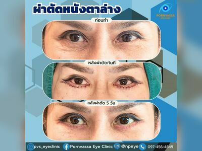 Pornvassa Eye Clinic