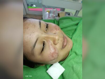 Krabi acne treatment Nanda