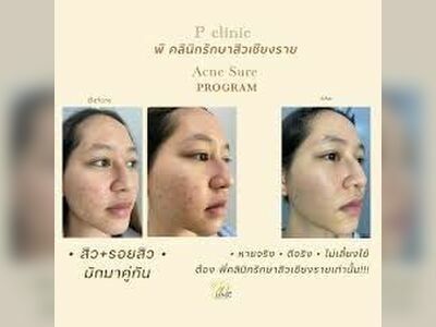 P Clinic Acne Treatment Chiang Rai