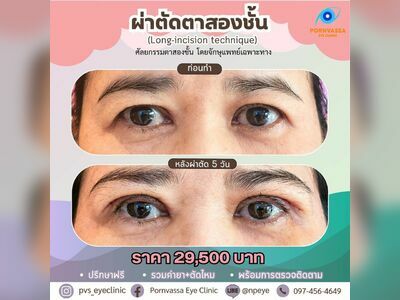 Pornvassa Eye Clinic