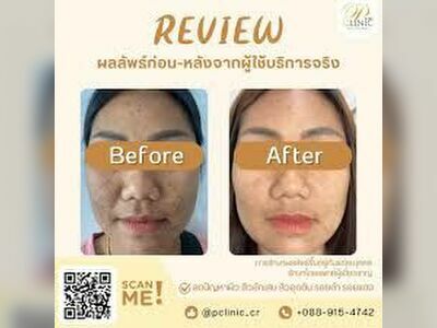 P Clinic Acne Treatment Chiang Rai
