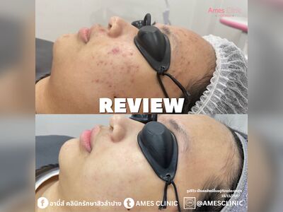 Ami's Clinic for Acne Treatment Lampang
