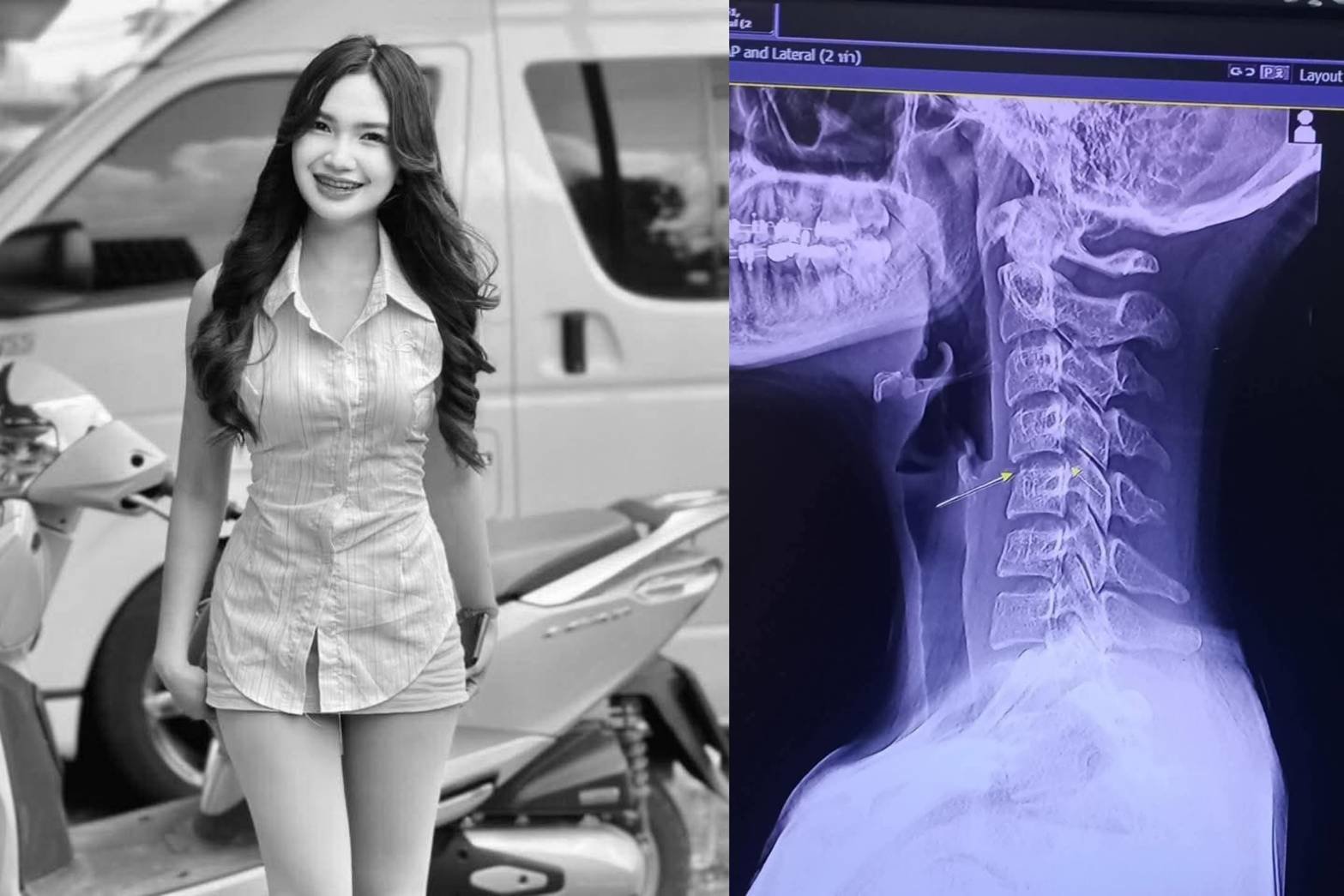 Fatal Risks of Neck-Twisting Massages