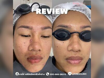 Ami's Clinic for Acne Treatment Lampang
