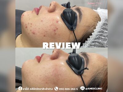 Ami's Clinic for Acne Treatment Lampang