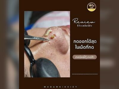 Pee Kung Acne Extraction Nong Khai