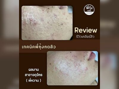 Pee Kung Acne Extraction Nong Khai