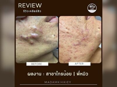 Pee Kung Acne Extraction Nong Khai