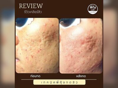 Pee Kung Acne Extraction Nong Khai